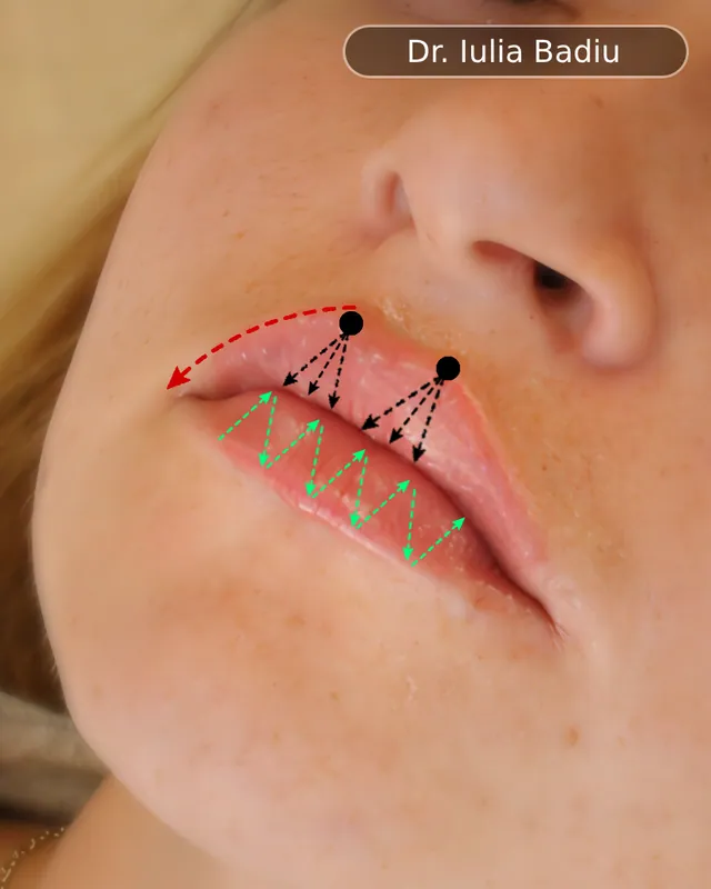 Schema tehnicii de augmentare a buzelor — Dr. Teo